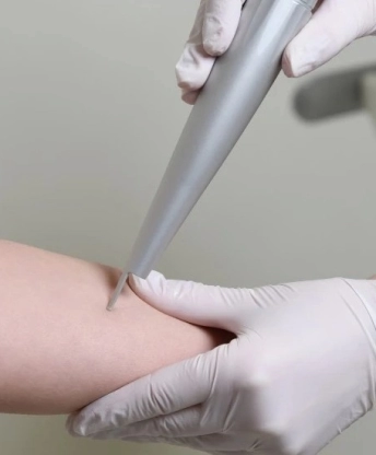 Kisméretű anyajegy eltüntetése CO2 lézerrel