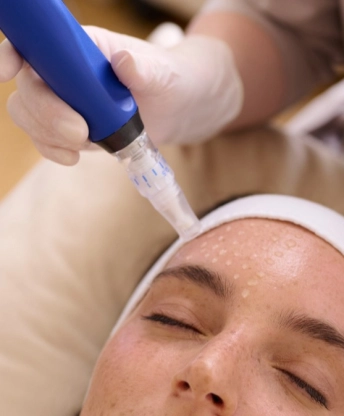SkinPen kezelés: menete, ára, utóápolása és kinek nem ajánlott