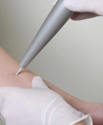 CO2 lézeres szemölcs eltávolítás 5. kerületi klinikánkon
