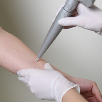 CO2 lézeres hámlasztás, bőrmegújítás