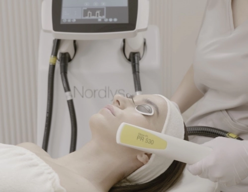 Nordlys IPL rosacea kezelés
