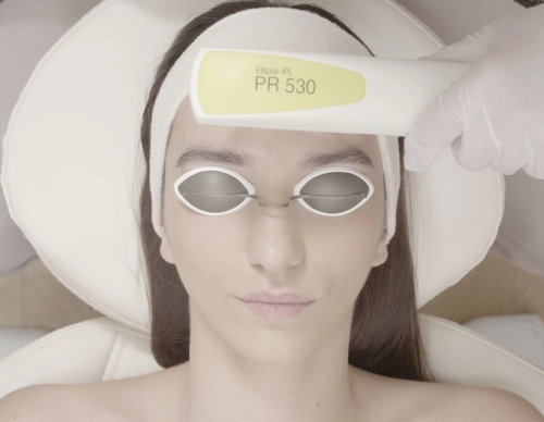 Nordlys IPL fotorejuvenáció / bőrfiatalítás