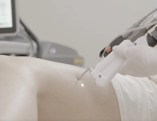Spider vein laser treatment